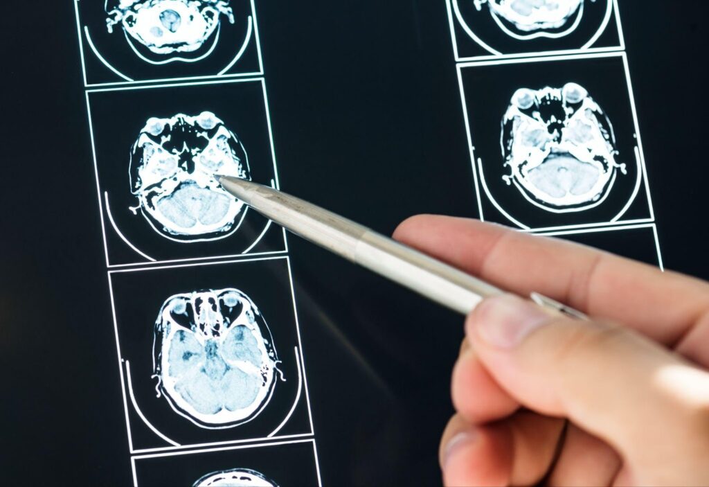 Close-up image of a brain MRI scan with a pen pointing to specific areas, highlighting the importance of diagnosing brain injuries and understanding the extent of damage.