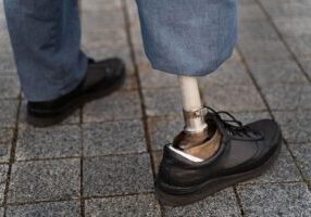 Close-up view of an individual with a prosthetic leg, standing on a paved surface. This image symbolizes the journey of recovery and adaptation after a traumatic amputation, focusing on topics such as rehabilitation, the use of prosthetics, and the pursuit of rightful compensation.